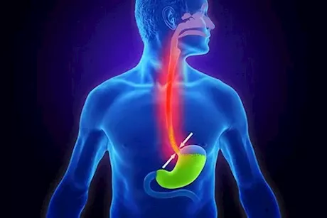 طبيب يحذر: هذه الأعراض تكشف إصابتك بالارتجاع الصامت "فيديو"