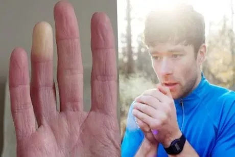 زيوت طبيعية تخفف متلازمة رينود في الشتاء- طبيب يوضح