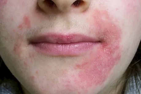 علاج التهاب حول الفم في المنزل- 5 وصفات قد تساعدك