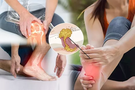 وداعًا لحمض اليوريك- 8 نصائح لعلاجه في أسبوع