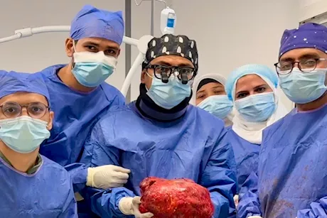 إنجاز طبي ببورسعيد.. استئصال ورم يزن 6 كجم بتكلفة 482 جنيه