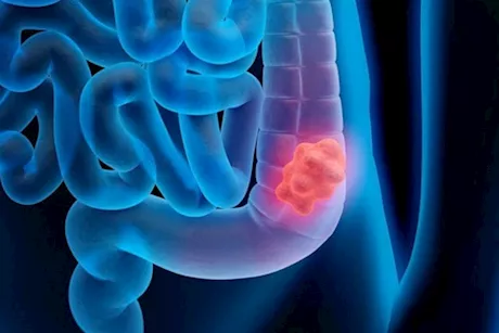 سرطان القولون عند الشباب- تجنبوا هذه المنتجات للوقاية