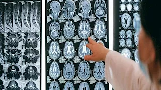 دراسة: مزيج مكملات غذائية يحقق نتائج واعدة ضد أخطر أورام الدماغ