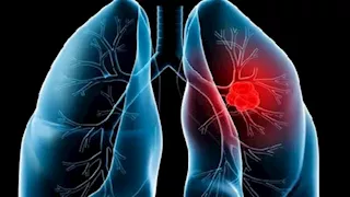 علامات مبكرة تكشف الإصابة بالجلطة الرئوية .. احذر تجاهلها