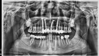 ضحية إهمال طبيب أسنان في الزقازيق يستغيث بوزارة الصحة