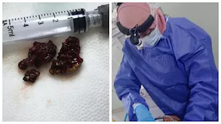  فريق طبي يستخرج حصوة من أنف سيدة ببني سويف