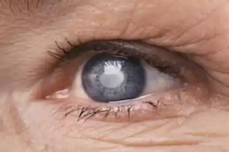 متى يفقد مريض الجلوكوما بصره؟.. طبيب يجيب 