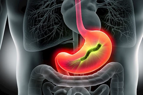  أسباب تهيج الغشاء المخاطي في المعدة - إليك مضاعفاته وطرق الوقاية منه