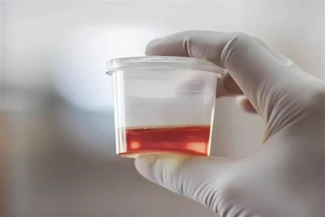 أمراض تسبب البول الدموي عند النساء 