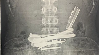 جراحة دقيقة تنقذ شابًا ابتلع ولاعات ومقصات بسوهاج