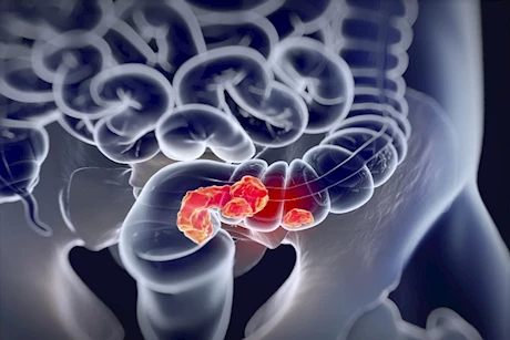 احذر منها - عادة يومية سيئة ترفع معدل الوفاة بسرطان القولون 