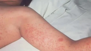 الحصبة تنهي حياة طفل في بريطانيا