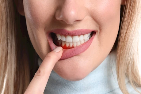 هل التهاب اللثة يسبب تلف للكلى؟