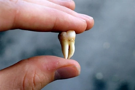 هل الخلع يقي من تسوس الأسنان؟.. طبيب يوضح