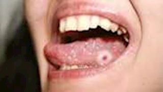 "تظهر على لسانك".. أعراض اصابتك بمرض مميت