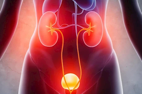 أدوية التهاب المسالك البولية- طبيب يوضح طريقة تناولها في رمضان