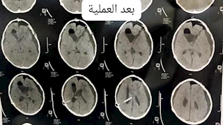  استئصال ورم ضخم من مخ طفلة في عملية جراحية ناجحة بجامعة أسيوط -صور 