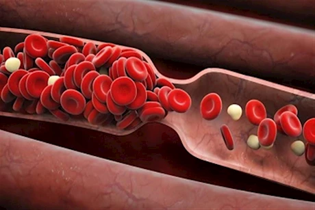 أطعمة لعلاج نقص الهيموجلوبين في الدم.. اعرفها