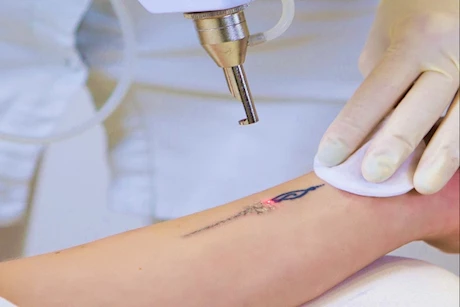 الوشم يسبب السرطان؟- طبيبة تحسم الجدل