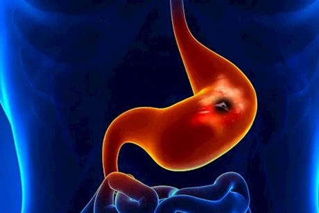 تسبب قرحة المعدة- 4 أطعمة تجنبها في السحور