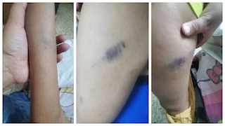 التلميذ جسمه أزرق.. أم تتهم مديرة مدرسة فى قنا بضرب ابنها المريض بالصفائح الدموية