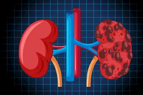 تظهر صباحًا- 5 أعراض لتلف الكلى انتبه إليها