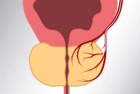 تعاني من تضخم البروستاتا؟- تجنب هذه المشروبات
