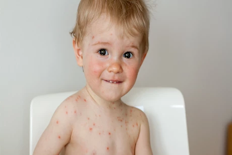 طبيب يحذر من إزالة الطفح الجلدي - يترك آثار دائمة 