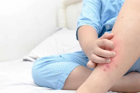 احذر حساسية الحشرات في الصيف - إليك طرق الوقاية 