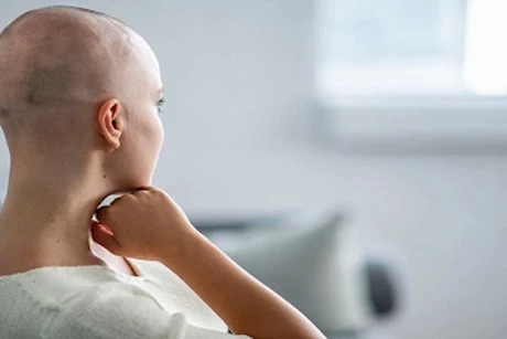 إليكِ 5 طرق لتحفيز نمو الشعر بعد العلاج الكيماوي