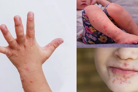 هذا الدواء ممنوع- كيف تعالجين طفلك من مرض اليد والقدم والفم؟ 