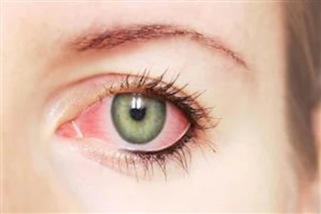 العين الوردية - إليك طرق علاجها