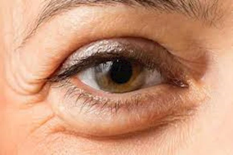 مكعبات ثلج الشاي الأخضر يعالج انتفاخات أسفل العينين