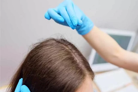 ما هو تحليل الشعر؟ ومتى يتم إجرائه ؟