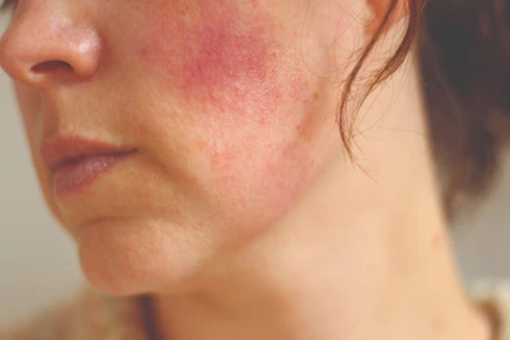 التهاب الجلد الدهني-كيف تحمي نفسك منه؟