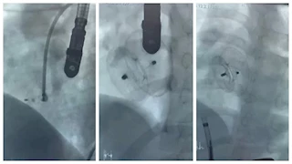 دون تدخل جراحي مفتوح.. إجراء 3 عمليات قلب دقيقة لأطفال بمستشفى سوهاج الجامعي