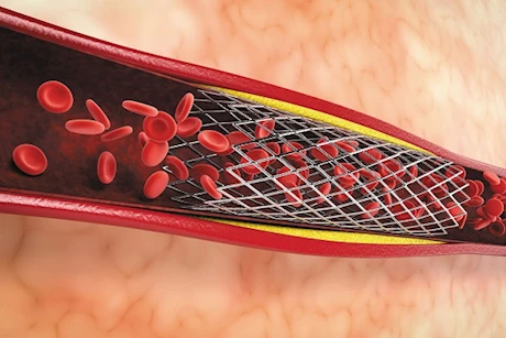 حسام موافي يحذر: هذه العادة العدو اللدود لدعامات القلب