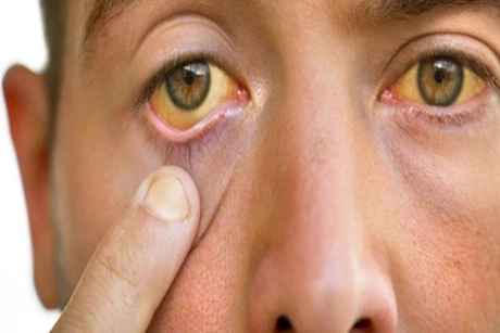 4 أسباب لاصفرار العينين -متى يجب استشارة الطبيب؟