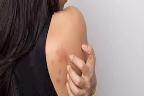 4 طرق منزلية لعلاج حساسية الجلد في الصيف