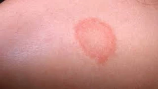 البقع الجلدية.. 5 أسباب خفية وراء تغير لون البشرة