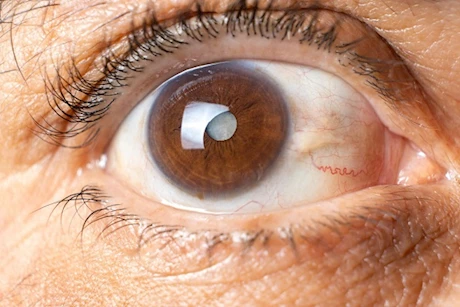 احذر- 5 علامات تكشف إصابتك بإعتام عدسة العين