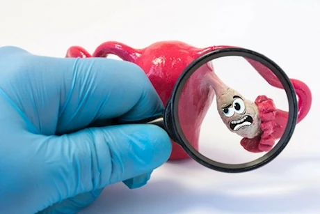 لعلاج تكيسات المبايض- 3 بذور احرصي على تناولها