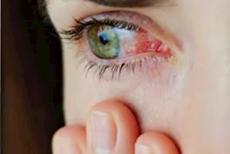 نصائح للحفاظ على العين في العاصفة الترابية.. طبيب يكشف 