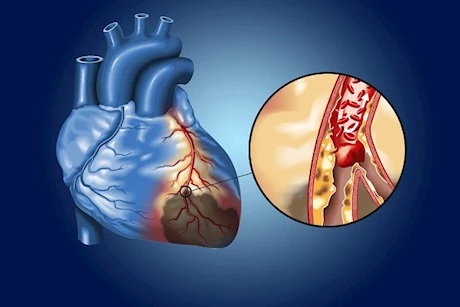 حسام موافي يحذر: هذه الأمراض تسبب ضيق الشريان التاجي