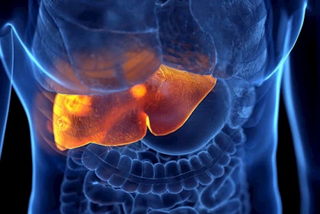 حسام موافي يكشف عن فحص ضروري لمرضى تليف الكبد