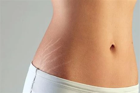 "جل الصبار" أبرزها.. طرق منزلية للتخلص من خطوط تمدد الجلد