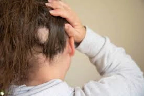 الثعلبة عند النساء- طبيبة توضح الأسباب والعلاج