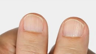 علامة على الأظافر تكشف إصابة امرأة بهذا النوع من السرطان 