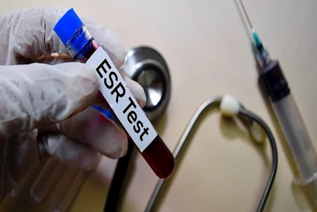 تحليل سرعة الترسيب.. متى يشير لوجود مشكلة؟ 