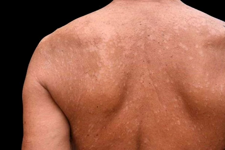 التينيا في الصيف تتزايد.. طبيب يوضح الأسباب وطرق العلاج